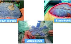 Laparostoma 2023 – Evidenzbasierter Versorgungsalgorithmus schwerster abdomineller Pathologien